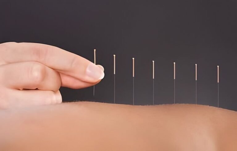 Acupuncture treatment in Islamabad and Rawalpindi